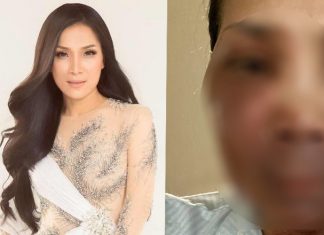 Ca sĩ Hồng Ngọc công khai khuôn mặt bỏng do nổ nồi xông hơi ai thấy cũng xót xa